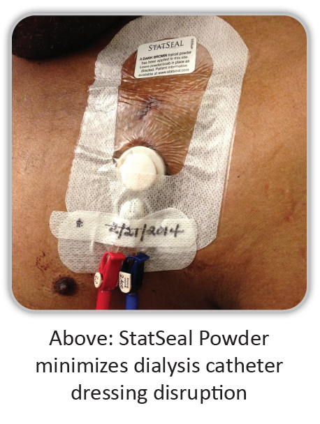 statseal-powder-tunnel-dialysis-catheter